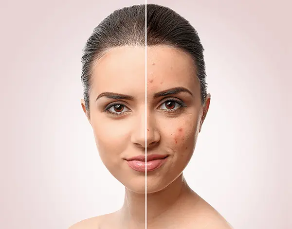 Skin Analysis