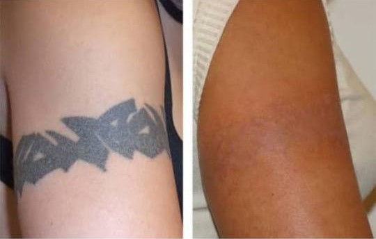 Laser Tattoo Removal Procedure