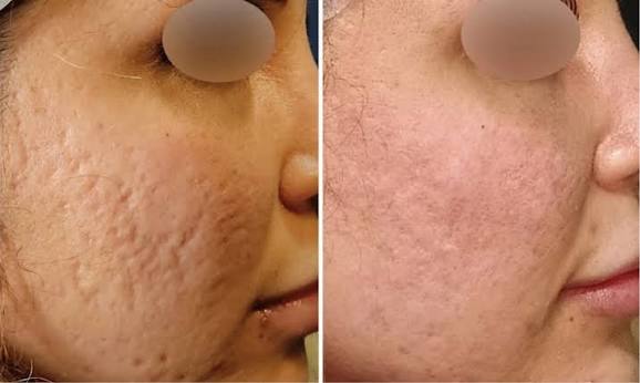 Skin Texture Analysis