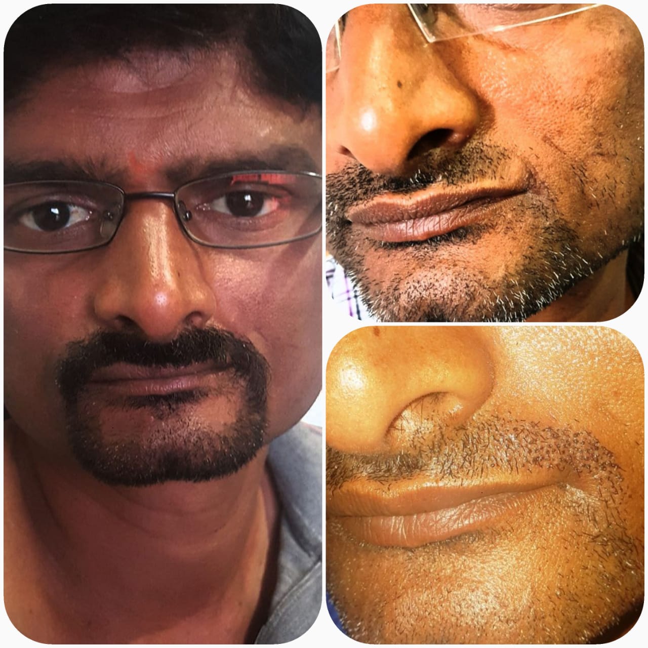 beard Treatment Result