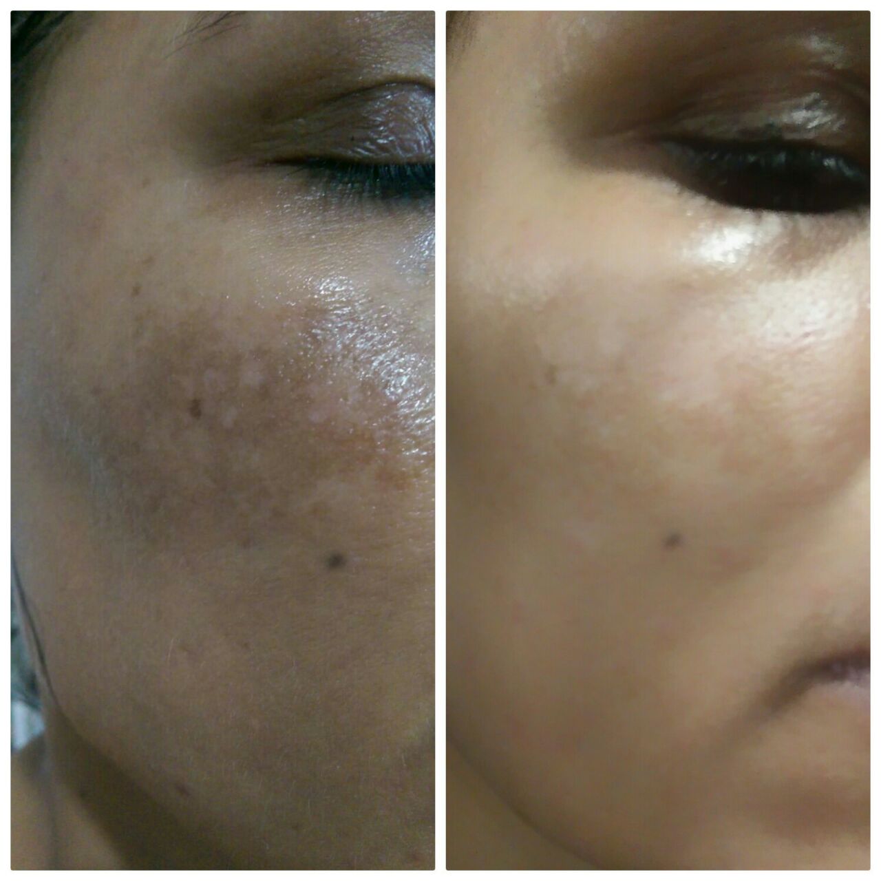 Skin Rejuvenation Result