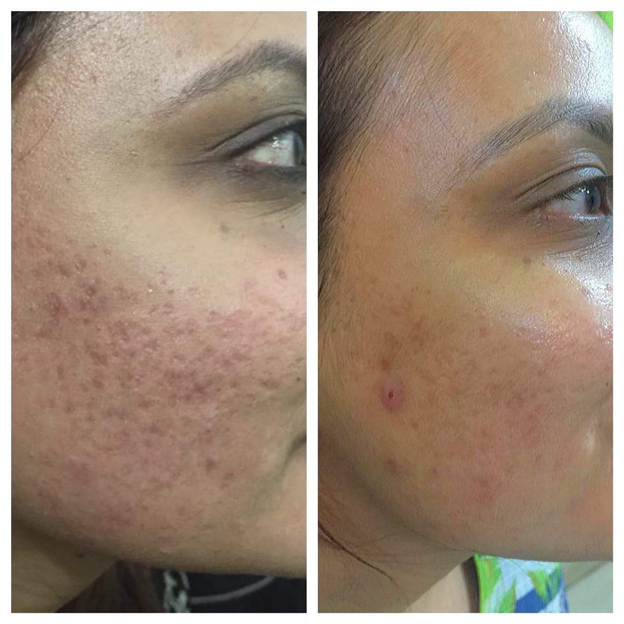 Skin Treatment Result