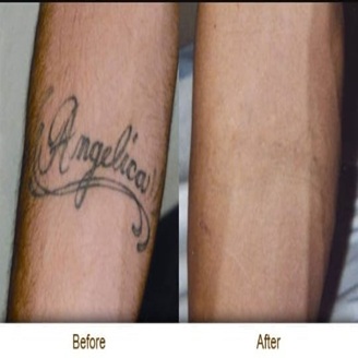 Tattoo Treatment Result
