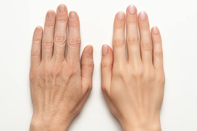 Hand Rejuvenation